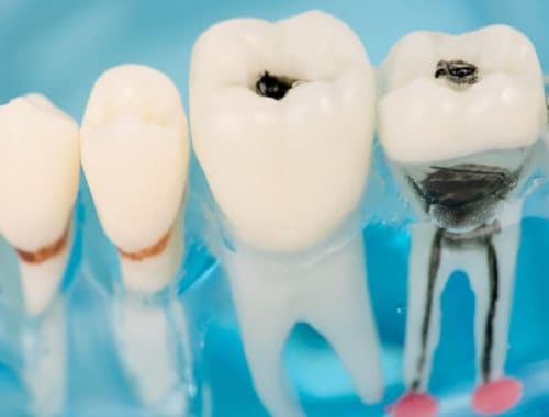 Canva Close up of dental model and caries 1 1
