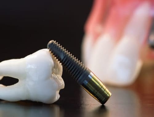 Canva Real Human Wisdom Tooth Implant Dental and Plastic Teeth Model