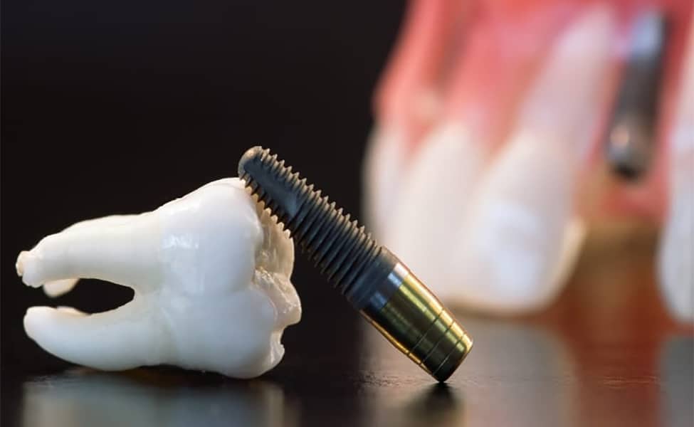 Canva Real Human Wisdom Tooth Implant Dental and Plastic Teeth Model