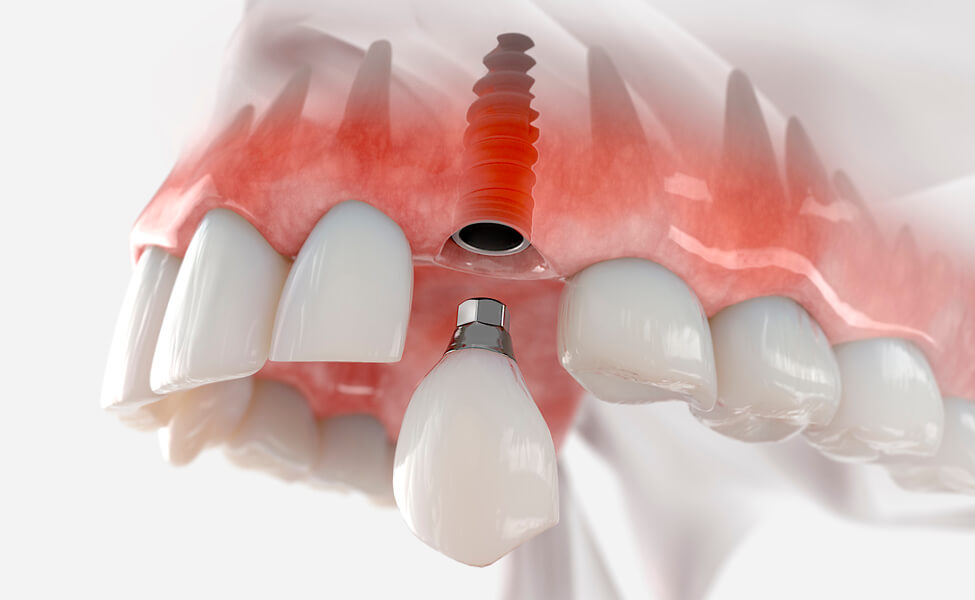 Animación de un implante dental
