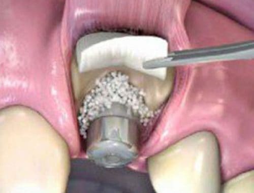 injerto de hueso para implante dental periodoncia e implantes monterrey