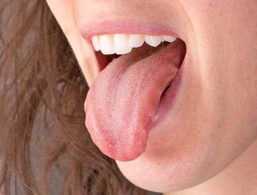 limpieza de la lengua periodoncia e implantes monterrey