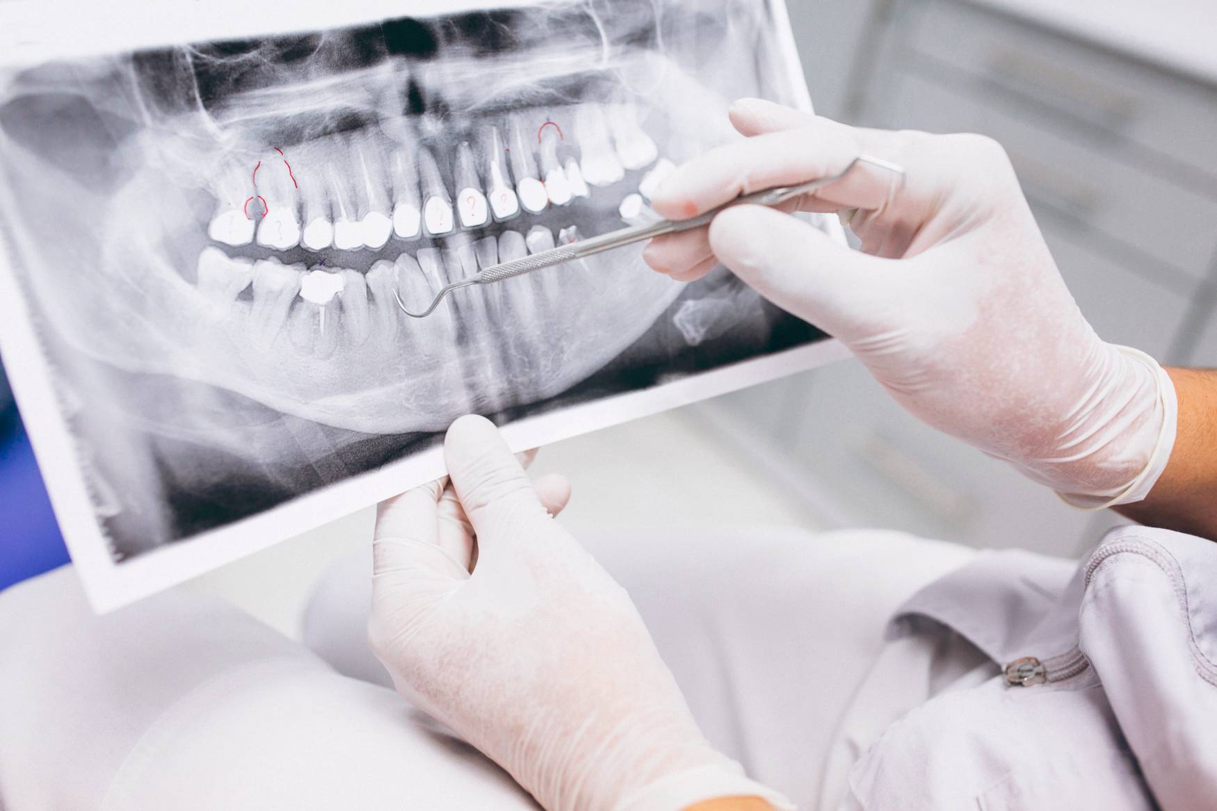 X-ray of teeth with periodontics