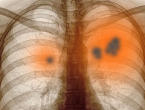 radiografia mostrando cancer pulmonar periodoncia e implantes monterrey
